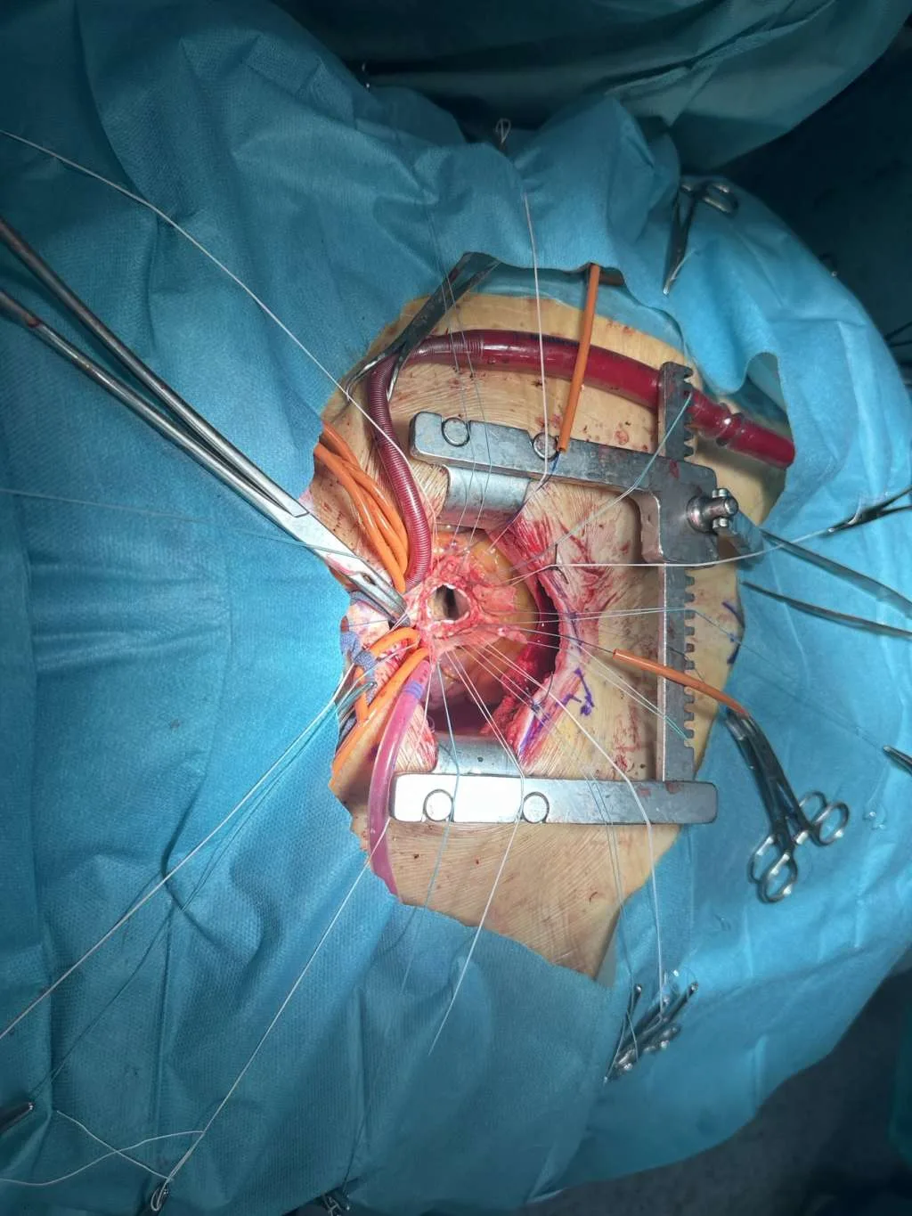 Nove minimalno invazivne procedure u UKC Tuzla |