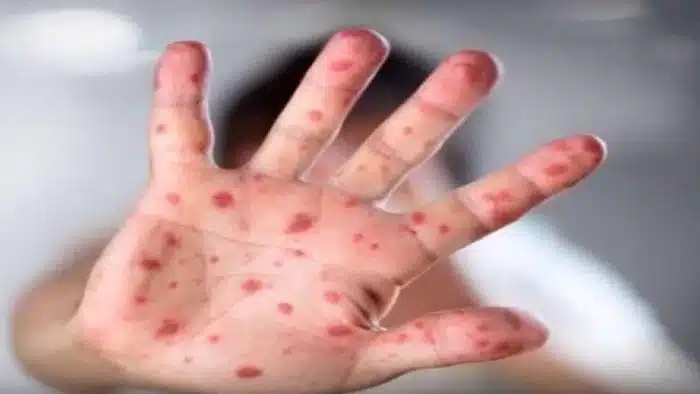 (VIDEO) Proglašena epidemija morbila na području Tuzle i Živinica