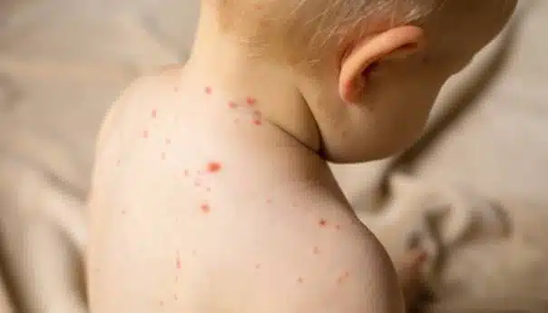 Pojava morbila kod djece u Tuzlanskom kantonu