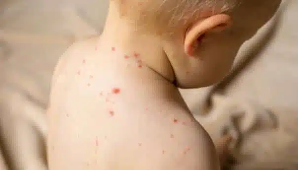 Proglašena epidemije morbila na području cijelog TK